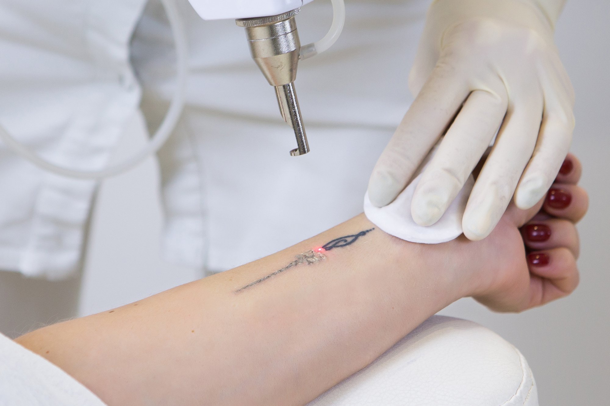 Laser tattoo removal